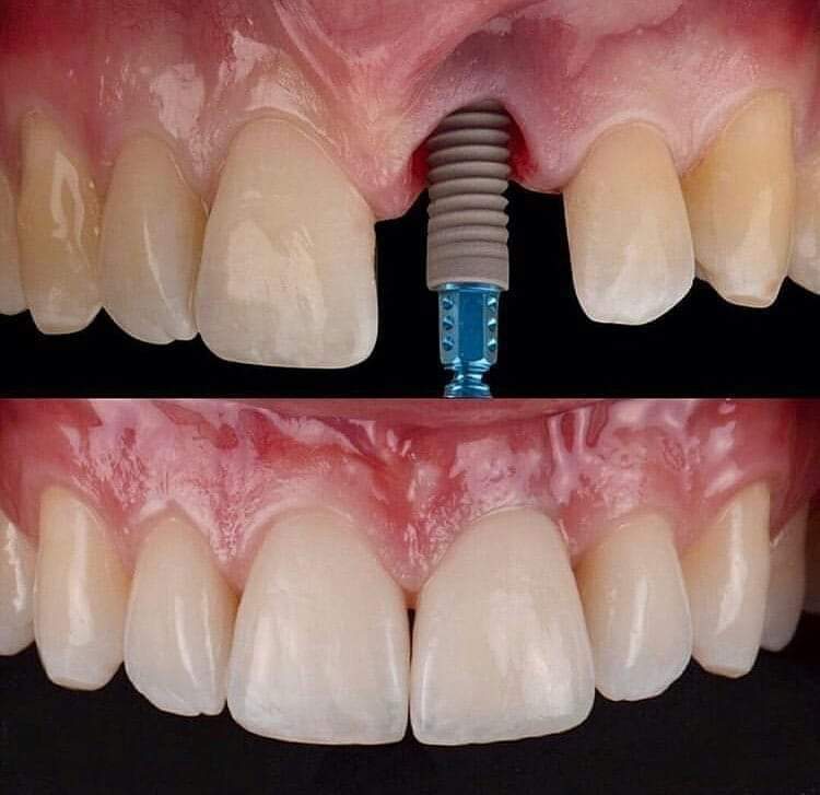 Aesthetic Implant