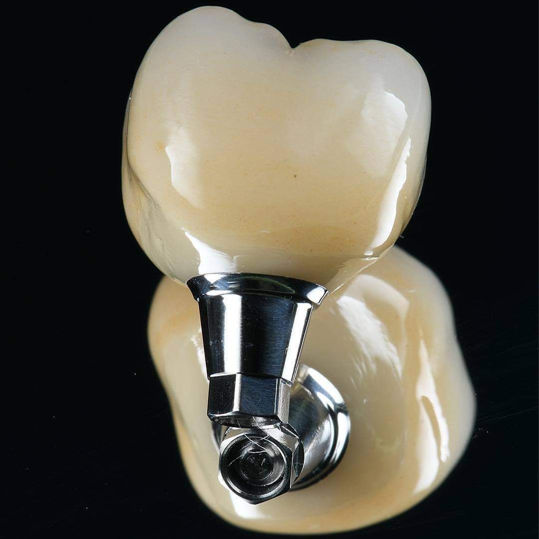 An image of titanium implants that illustrating the osseointegration process.