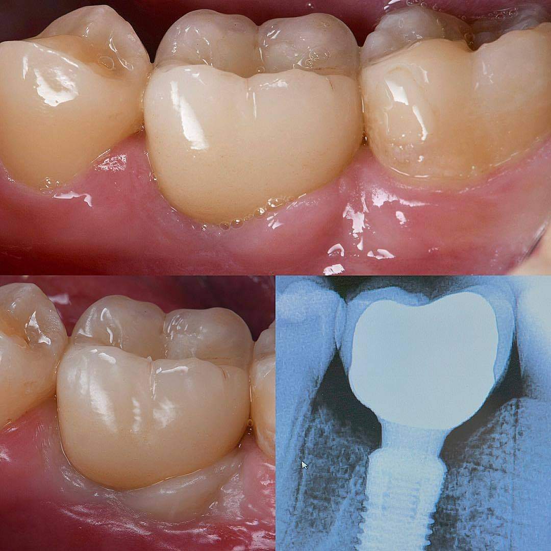 An image of titanium implants that illustrating the osseointegration process.