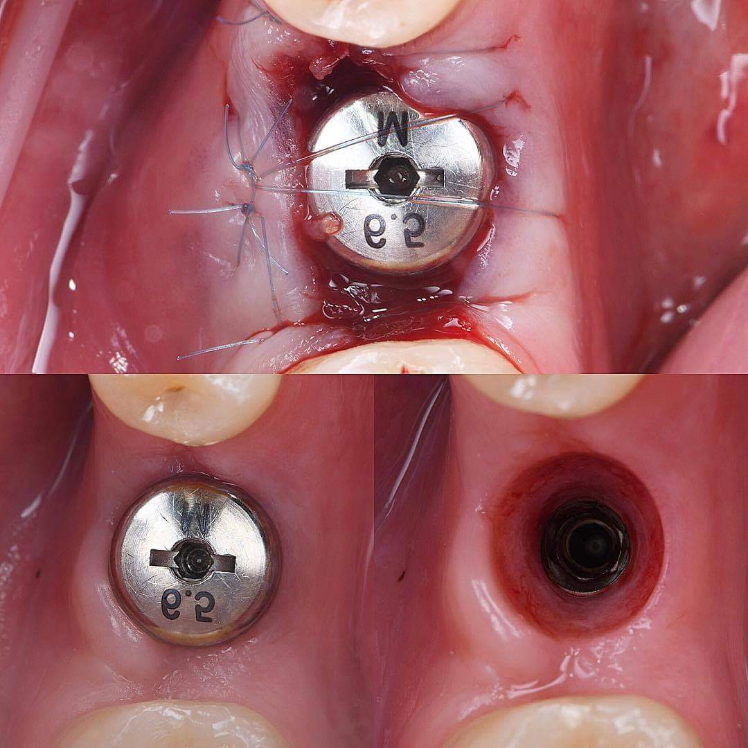 An image of titanium implants that illustrating the osseointegration process.