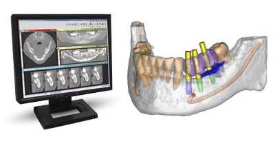 Ezzy-Dental picture of a 3d scan for implant surgery